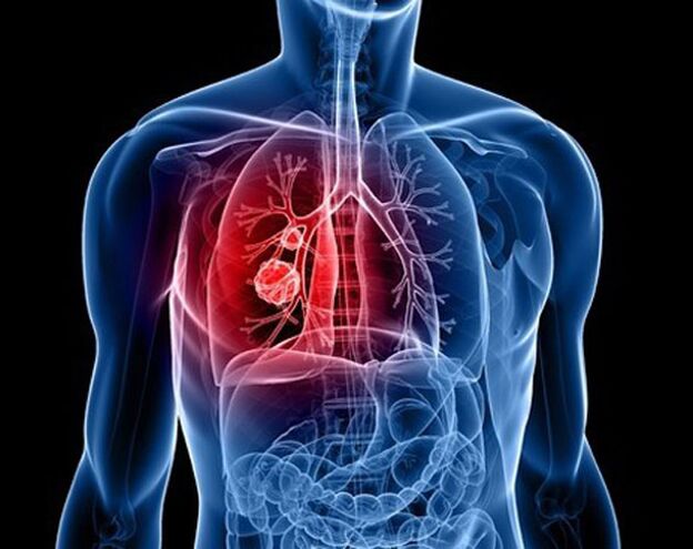 Paraziták a tüdőben